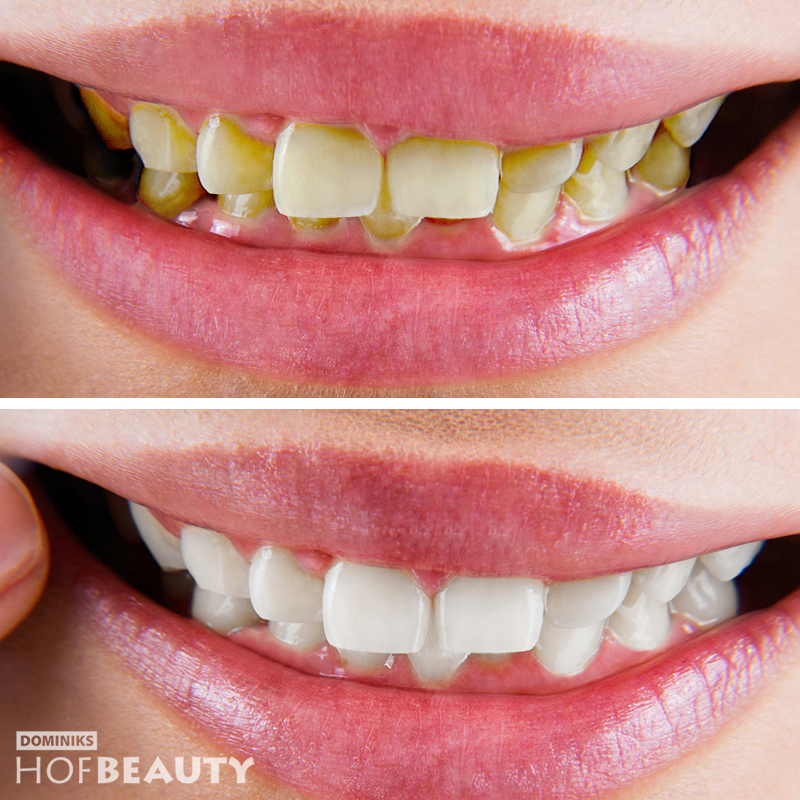 HofBeauty-Kosmetische-Zahnreinigung-vorher-nachher-Frau