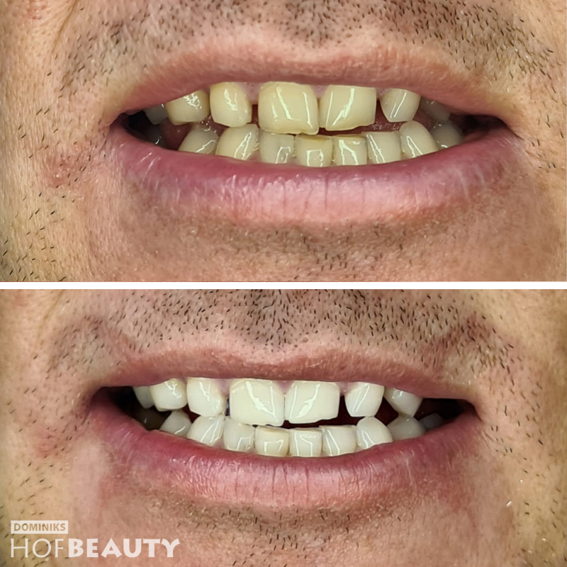 HofBeauty-Kosmetische-Zahnreinigung-vorher-nachher-Mann
