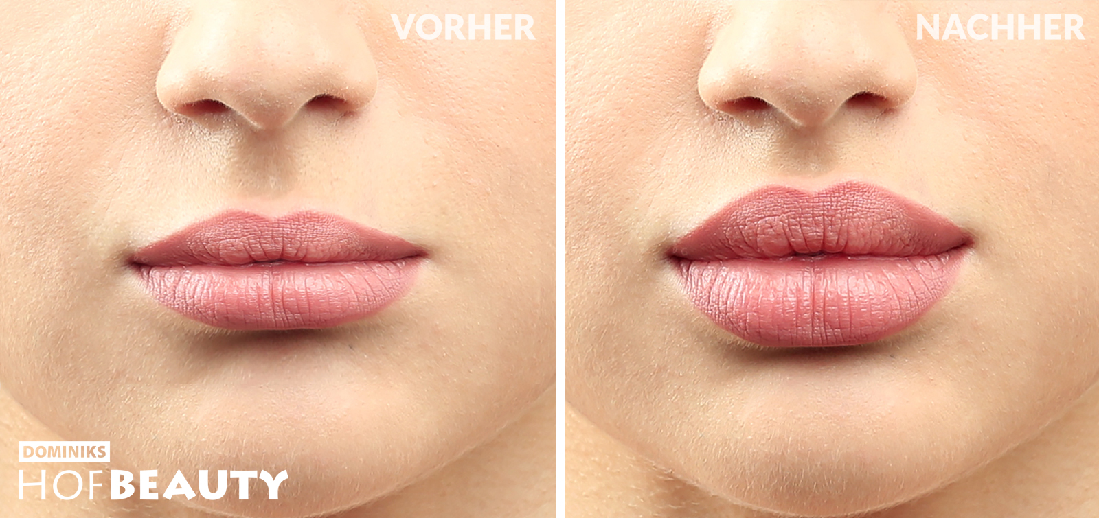 Hyaluron Behandlung Lippen aufpolstern_vorher-nachher_Kosmetikstudio HofBeauty