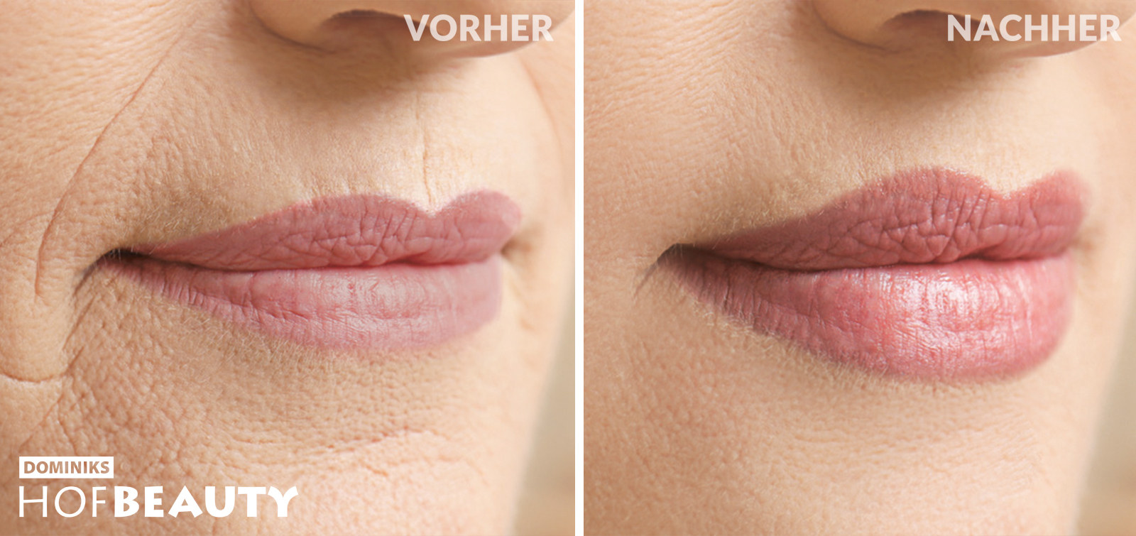 Hyaluron Behandlung Lippen aufpolstern und Falten reduzieren_vorher-nachher_Kosmetikstudio HofBeauty