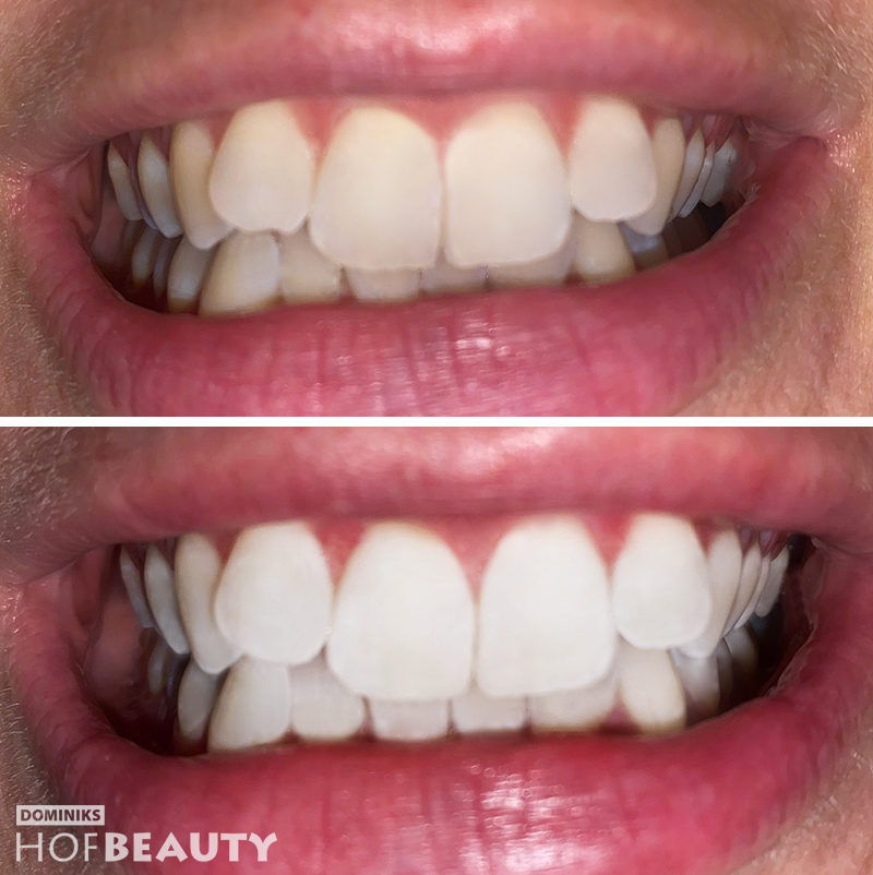 DOMINIKS-HOFBEAUTY-Kosmetische-Zahnaufhellung-vorher-nachher