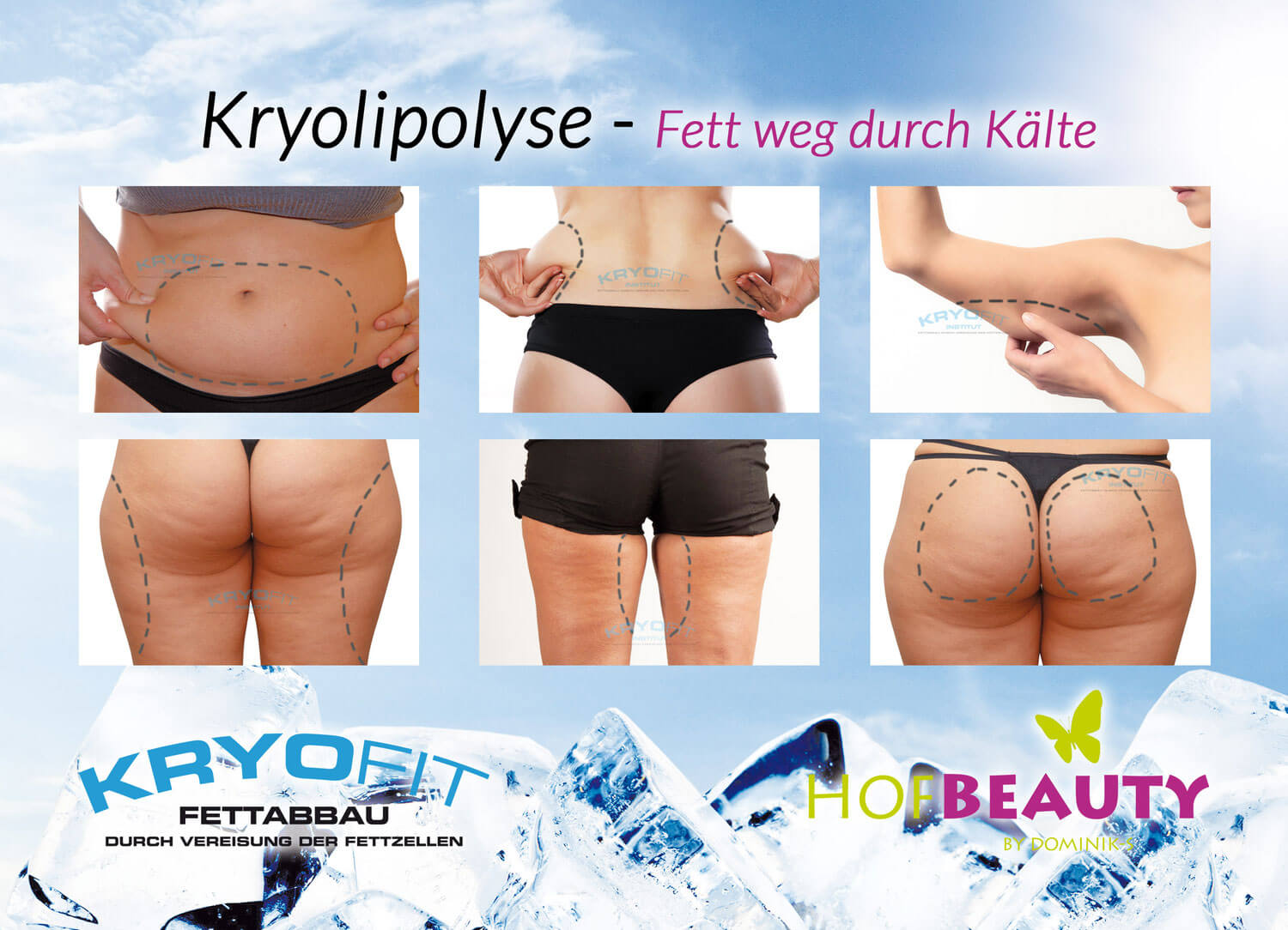 Kryolipolyse Kryofit Kryolipolyse Studio By Dominiks